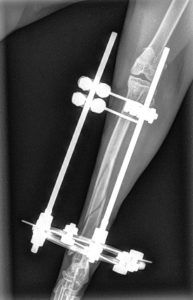 X-ray post surgery